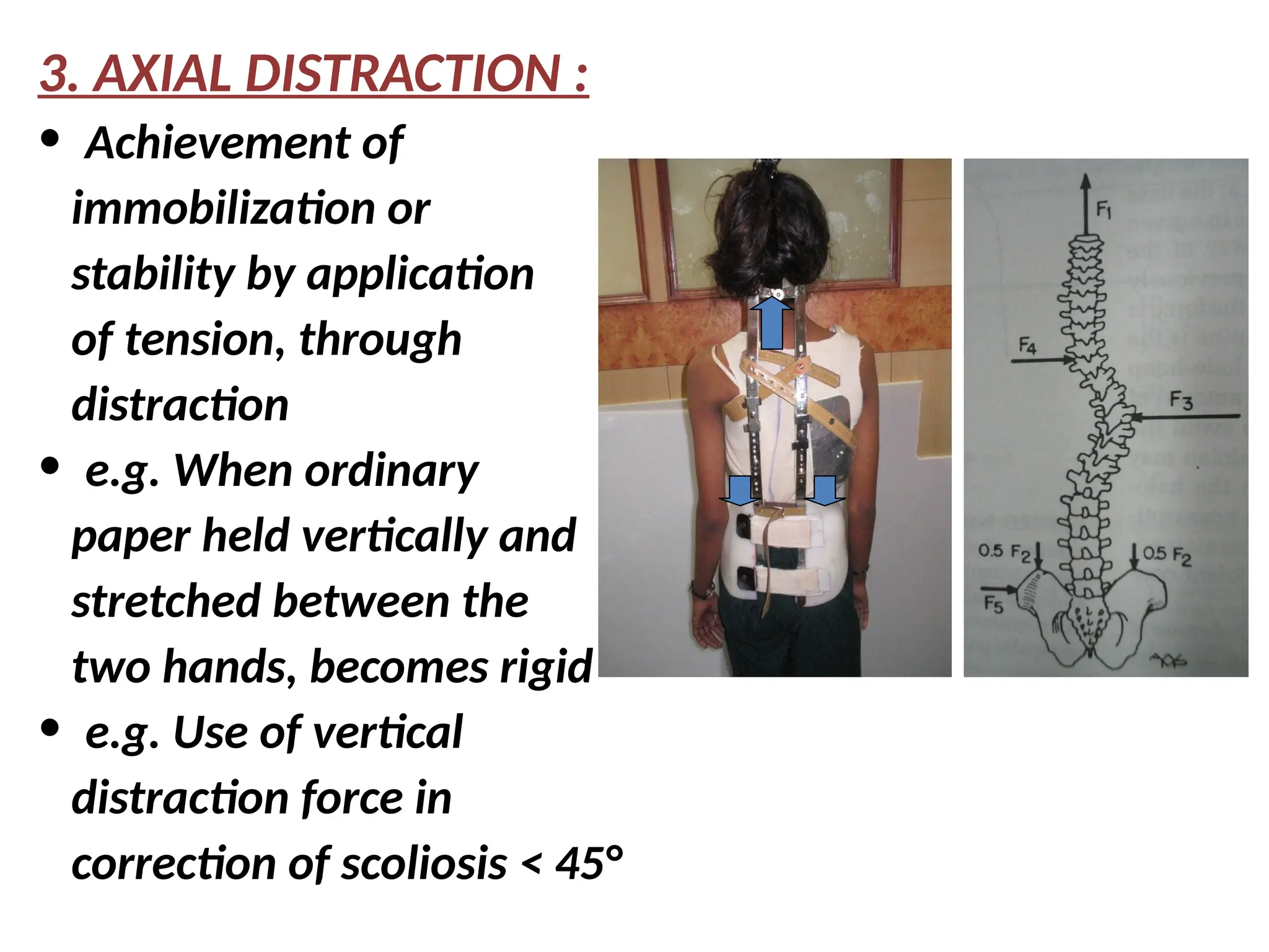 3. AXIAL DISTRACTION :
• Achievement of
immobilization or
stability by application
of tension, through
distraction
• e.g. When ordinary
paper held vertically and
stretched between the
two hands, becomes rigid
• e.g. Use of vertical
distraction force in
correction of scoliosis < 45°
 