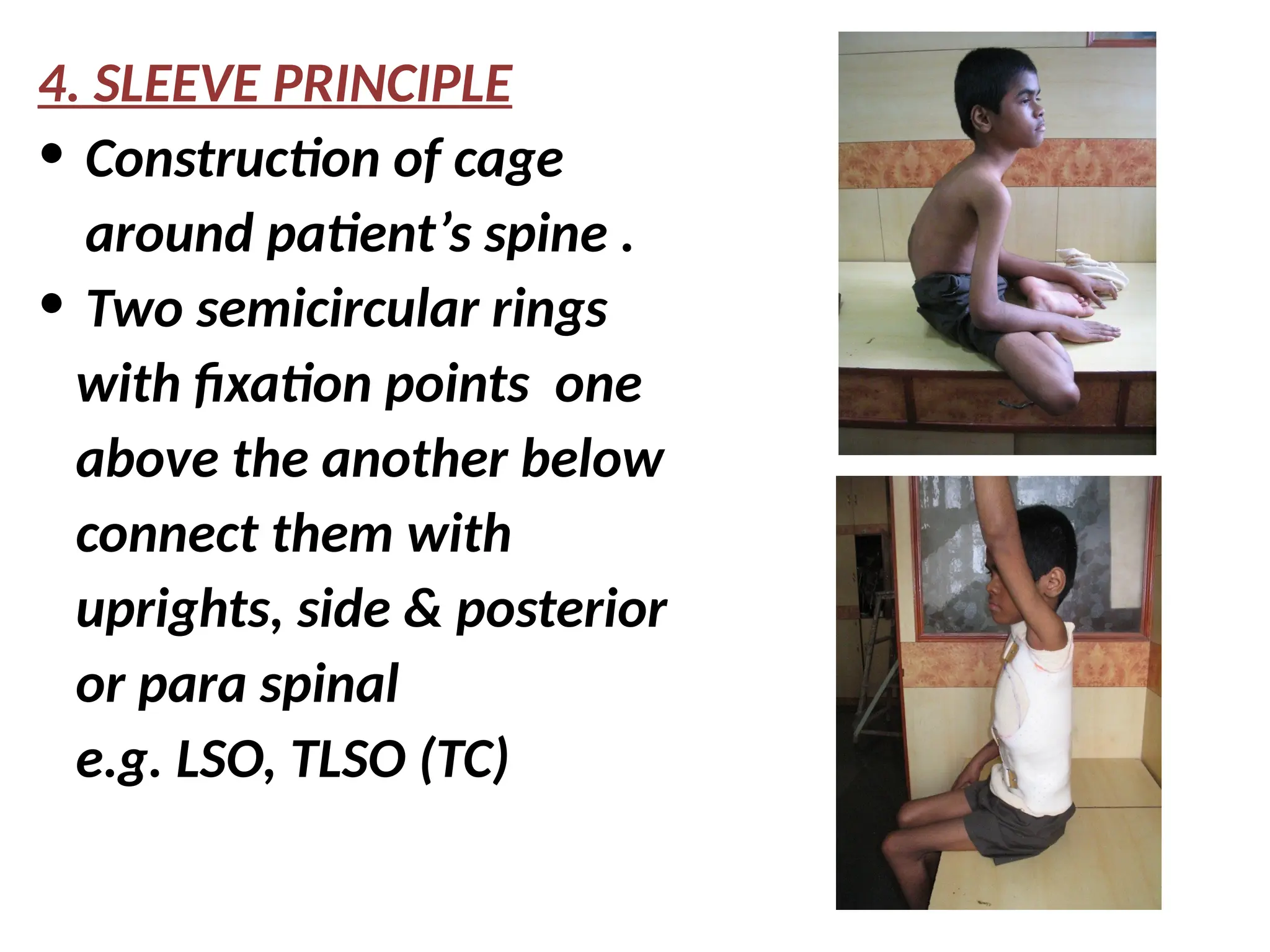 4. SLEEVE PRINCIPLE
• Construction of cage
around patient’s spine .
• Two semicircular rings
with fixation points one
above the another below
connect them with
uprights, side & posterior
or para spinal
e.g. LSO, TLSO (TC)
 