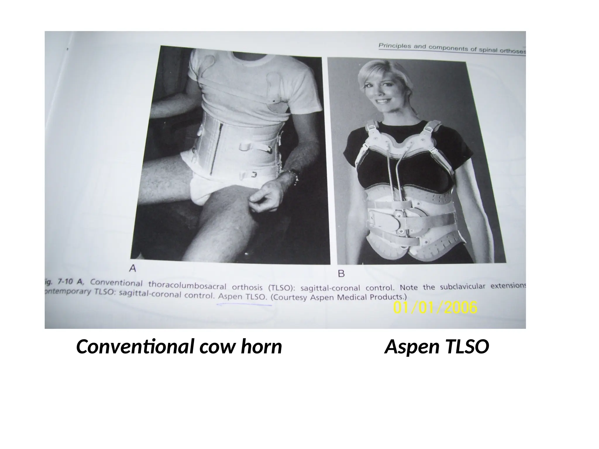 Conventional cow horn Aspen TLSO
 