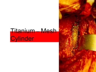 Titanium – Mesh
Cylinder
 