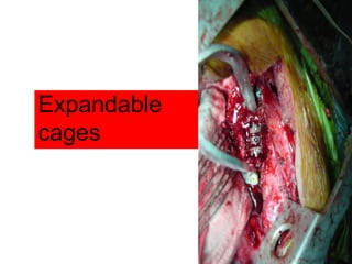 Expandable
cages
 