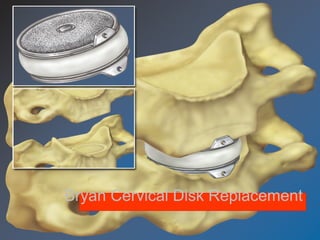 Bryan Cervical Disk Replacement
 