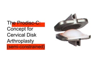 The Prodisc-C:
Concept for
Cervical Disk
Arthroplasty
(semi-constrained)
 