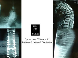 Π.Μ.
F 80
28-7-06
Osteoporosis: T-Score: - 3.5
Posterior Correction & Stabilization
 