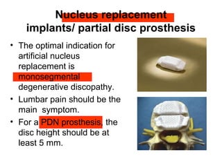 Nucleus replacement
implants/ partial disc prosthesis
• The optimal indication for
artificial nucleus
replacement is
monosegmental
degenerative discopathy.
• Lumbar pain should be the
main symptom.
• For a PDN prosthesis, the
disc height should be at
least 5 mm.
 