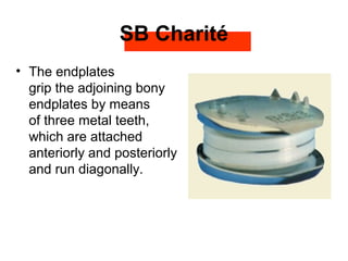 SB Charité
• The endplates
grip the adjoining bony
endplates by means
of three metal teeth,
which are attached
anteriorly and posteriorly
and run diagonally.
 