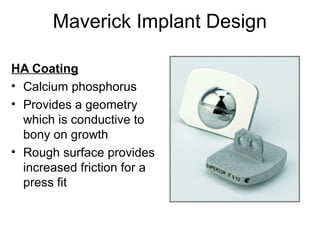 Maverick Implant Design
HA Coating
• Calcium phosphorus
• Provides a geometry
which is conductive to
bony on growth
• Rough surface provides
increased friction for a
press fit
 