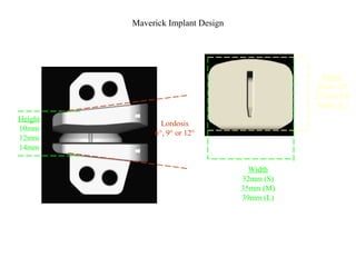 Maverick Implant Design
Inferior Component
Six sizes available:
Width
32mm (S)
35mm (M)
39mm (L)
Superior Component
Eighteen sizes available:
Height
10mm
12mm
14mm
Lordosis
6°, 9° or 12°
Depth
25mm (S)
27mm (M)
30mm (L)
 