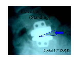 Extension Bending
(Standing)
+2°
(Total 15° ROM)
 