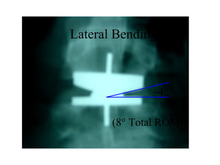 -4°
(8° Total ROM)
Lateral Bending
 