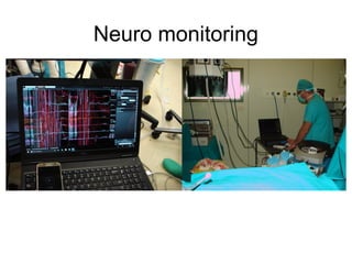 Neuro monitoring
 