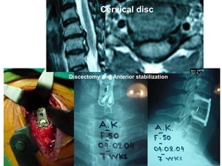 Cervical disc
Discectomy and Anterior stabilization
 