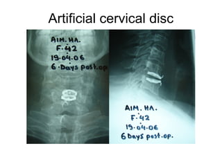 Artificial cervical disc
 