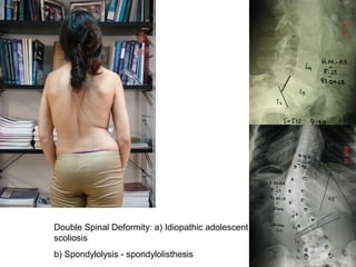 Double Spinal Deformity: a) Idiopathic adolescent
scoliosis
b) Spondylolysis - spondylolisthesis
 