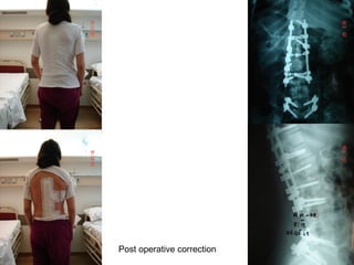Post operative correction
 