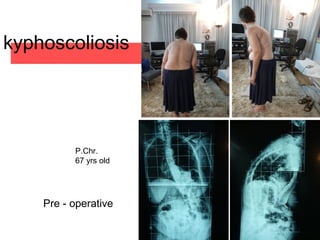 kyphoscoliosis
P.Chr.
67 yrs old
Pre - operative
 