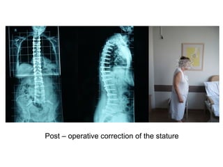 Post – operative correction of the stature
 