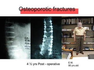 Osteoporotic fractures
E.M.
90 yrs old
4 ½ yrs Post - operative
 