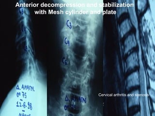 Anterior decompression and stabilization
with Mesh cylinder and plate
Cervical arthritis and stenosis
 