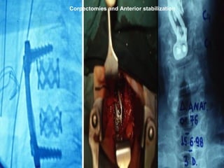 Corpectomies and Anterior stabilization
 