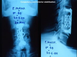 Corpectomy and Anterior stabilization
 