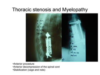 Thoracic stenosis and Myelopathy
•Anterior procedure
•Anterior decompression of the spinal cord
•Stabilization (cage and rods)
 