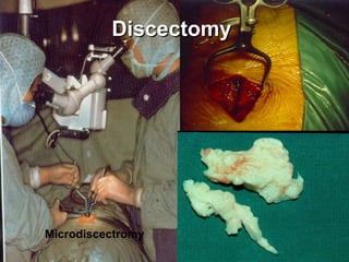 DiscectomyDiscectomy
Microdiscectromy
 