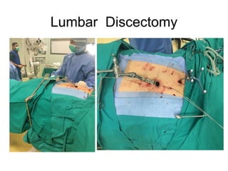 Lumbar Discectomy
 