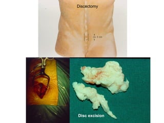 Discectomy
Disc excision
 