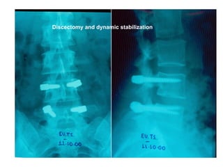 Discectomy and dynamic stabilization
 