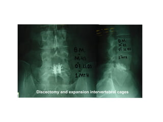 Discectomy and expansion intervertebral cages
 