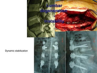 LumbarLumbar
degenerationdegeneration
--
instabilityinstability
Dynamic stabilization
 