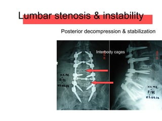 Lumbar stenosis & instability
Posterior decompression & stabilization
Interbody cages
 
