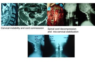 Cervical instability and cord comresssion Spinal cord decompression
and inio-cervical stabilization
 
