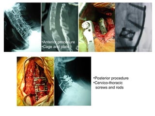 •Anterior procedure
•Cage and plate
•Posterior procedure
•Cervico-thoracic
screws and rods
 
