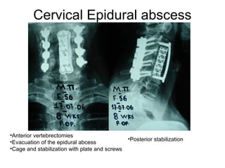 Cervical Epidural abscess
•Anterior vertebrectomies
•Evacuation of the epidural abcess
•Cage and stabilization with plate and screws
•Posterior stabilization
 