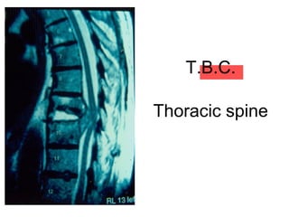 T.B.C.
Thoracic spine
 