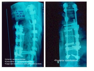 •Anterior vertebrectomies
•Evacuation of the epidural abcess
•Cage and stabilization with plate and screws
•Posterior stabilization
 