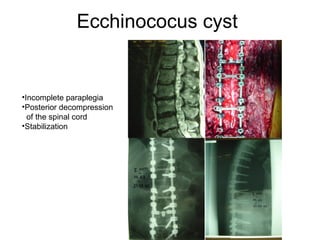 Ecchinococus cyst
•Incomplete paraplegia
•Posterior decompression
of the spinal cord
•Stabilization
 