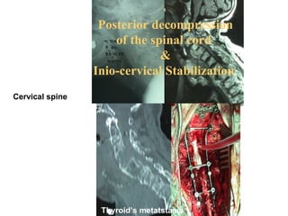 Thyroid’s metatstasis
Posterior decompression
of the spinal cord
&
Inio-cervical Stabilization
Cervical spine
 