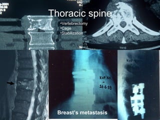 Breast’s metastasis
Thoracic spine
•Vertebrectomy
•Cage
•Stabilization
 