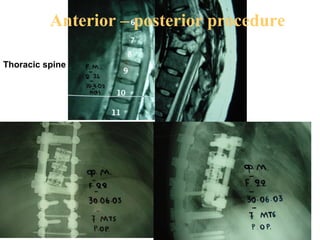 Thoracic spine
Anterior – posterior procedure
 