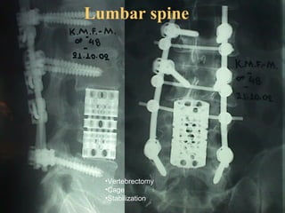 Lumbar spine
•Vertebrectomy
•Cage
•Stabilization
 