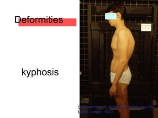 Scheuermann H. Kyphosis dorsalis juvenilis,Scheuermann H. Kyphosis dorsalis juvenilis,
Ugekr Laeger, 1920Ugekr Laeger, 1920
Deformities
kyphosis
 