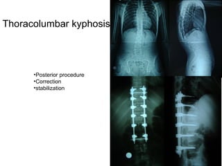 Thoracolumbar kyphosis
•Posterior procedure
•Correction
•stabilization
 