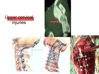 Upper cervical
injuries
C2
 