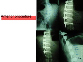 Anterior procedure
 