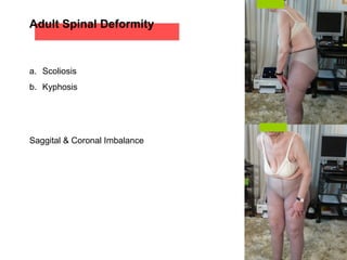 a. Scoliosis
b. Kyphosis
Saggital & Coronal Imbalance
Adult Spinal Deformity
 