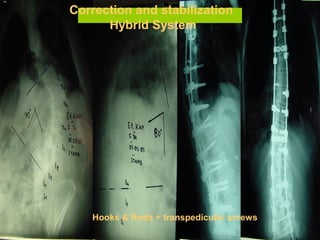 Hooks & Rods + transpedicular screws
Correction and stabilization
Hybrid System
 