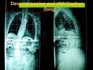 Decompression and stabilization
(long)
 